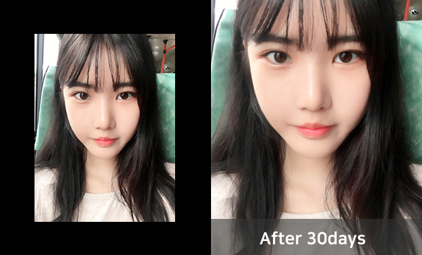 짱이뻐! - Surprised by Korea Rhinoplasty And More Satisfied By Envy And Jealousy From My Friends