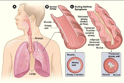 What Does Asthma Feel like