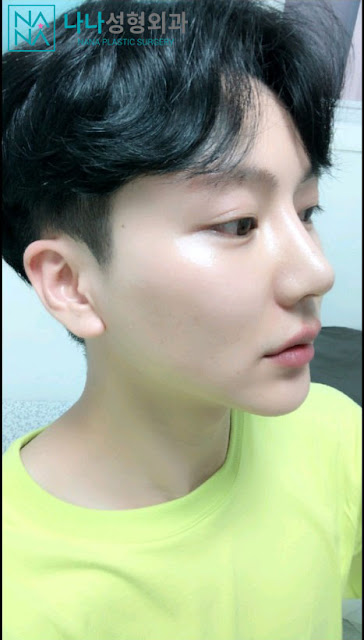 rhinoplasty, revision nose job, revision rhinoplasty, nose job, korean plastic surgery, nose job in korea, rhinoplasty in korea, korea plastic surgery, plastic surgery in korea, revision surgery, revision nose, revision rhino, asian rhinoplasty