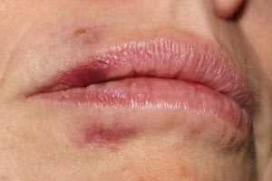 como se cura el herpes labial