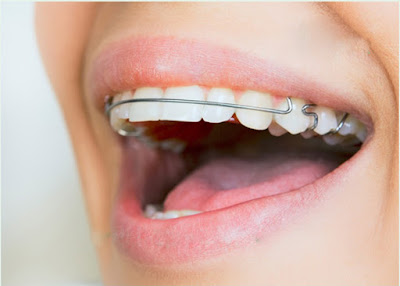 Niềng răng hô hàm trên áp dụng cho đối tượng nào
