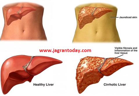 यकृत को स्वस्थ रखने के घरेलू उपाय
