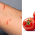 TOMATO FLU SYMPTOMS THAT LEAVES CHILDREN WITH RED BLISTERS
