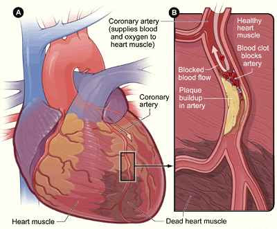 symptomps Heart attack