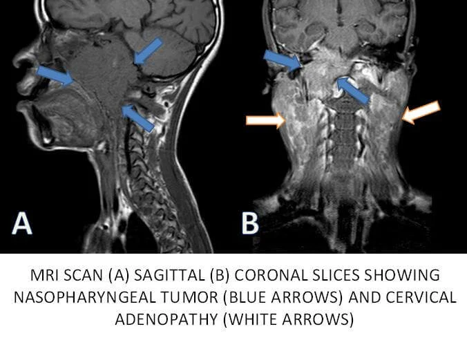 mri-nasopharyngeal-cancer