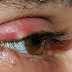 Have you ever had a Stye (Hordeolum) or Chalazion in your Eye?