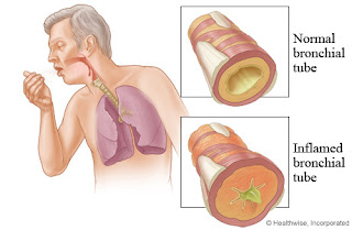 The definition of acute bronchitis 