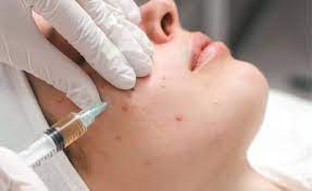 Benefits of PRP Treatment for Skin Brightening