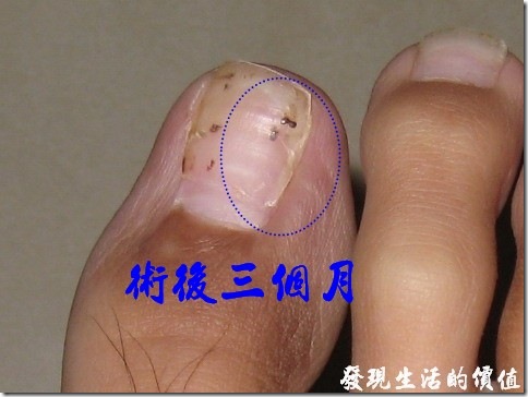 凍甲(台)/甲溝炎/趾甲內生症/腳趾甲刺到肉內 術後三個月追蹤