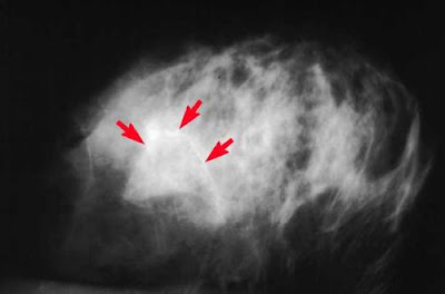 Diagnostic Mammogram