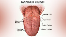 Kanker Lidah