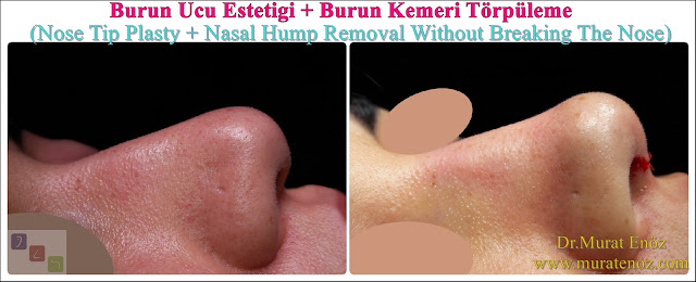 Burun Ucu Estetiği + Burun Kemeri Törpüleme (Nose Tip Plasty + Nasal Hump Removal Without Breaking The Nose)