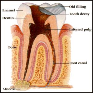 Tooth Abscess: Causes, Symptoms, Diagnosis, Treatment, Prevention