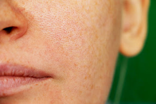 Open Pores-20 Home REMEDIES To Get Rid Of Open Pores On Skin , open pores face images