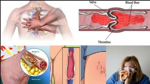 Six Signs That You Have A Blood Clot