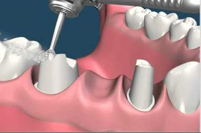 Làm cầu răng khắc phục tình trạng mất răng nên không?