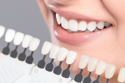 Kinh nghiệm trồng răng sứ dành cho bạn