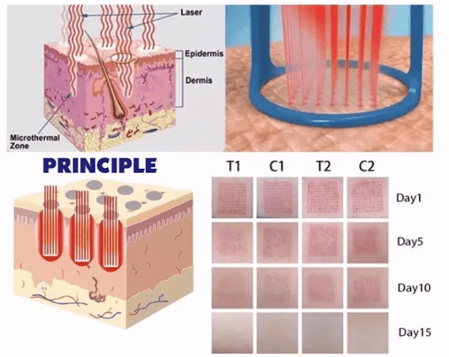 laser hair removal machine