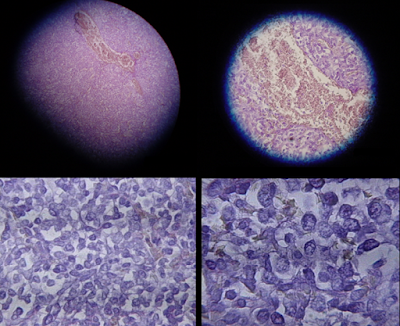 Immunochemistry of Mesothelioma