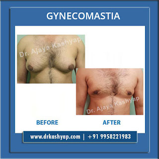 gynecomastia surgery in south delhi