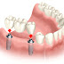  Ưu điểm và hạn chế cầu răng sứ titan