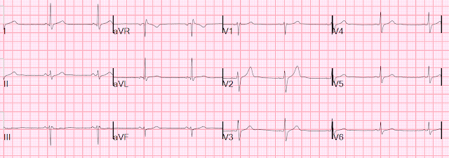 Why do we NOT name Occlusion MI (OMI) after an EKG finding? (In contrast to STEMI, which is named after ST Elevation)