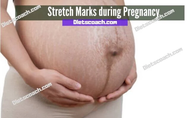 Stretch marks cause pregnancy