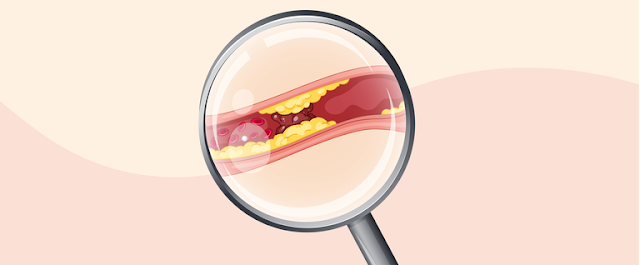 Welches Cholesterin ist schlecht? Was ist gutes Cholesterin? Wie kann man Cholesterin vermeiden?