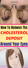 How To Remove The Cholesterol Deposits Around Your Eyes