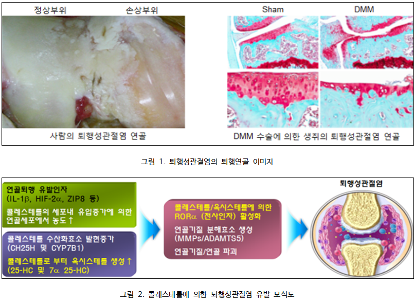 관절연골 콜레스테롤이 퇴행성관절염 원인 세계 최초 증명