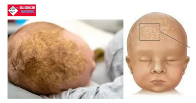 What Is a Cradle Cap?