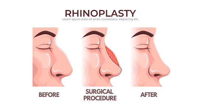 is rhinoplasty Surgery safe? - Heakthegy