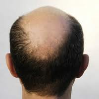 En dermatologie, l'alopécie désigne l'accélération de la chute des cheveux et/ou des poils. Le terme vient du grec alopex (renard) à cause de la chute annuelle, au début du printemps, des poils d'hiver de cet animal.