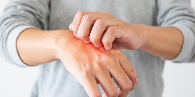 Eczema causes, symptoms and treatment - pictures-photos-images