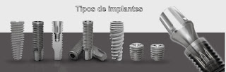 implante titanium