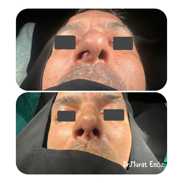 Caudal Septoplasty - Open Technique Septoplasty