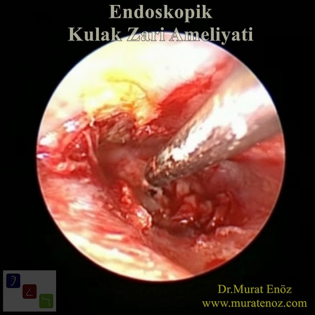 Endoskopik Kulak Zarı Ameliyatı - Endoskopik Miringoplasti - Endoskopik Kulak Zarı Tamiri - Endoskopik Miringoplasti - Transkanal Endoskopik Miringoplasti - Endoskopik Kulak Zarı Operasyonu - Transcanal Endoscopic Myringoplasty - Endoscope Assisted Myringoplasty, Endoscopic Myringoplasty - Endoscopic-Assisted Myringoplasty - Endoscopic Eardrum Hole Surgery - Endoscopic Repair of Tympanic Membrane Perforation