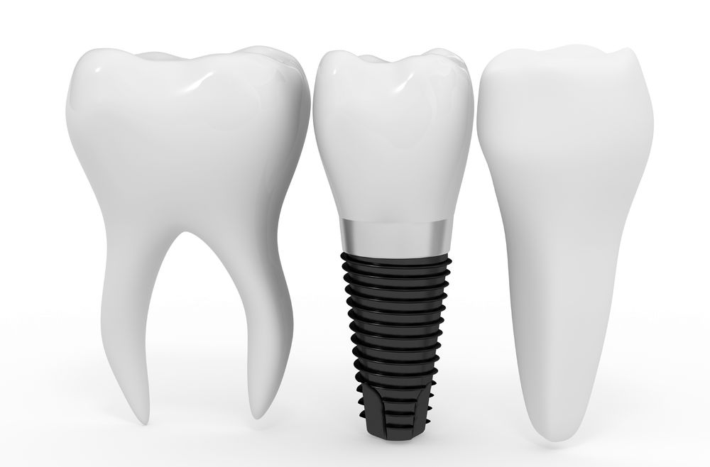 Dental Implants