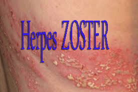 Pengobatan Penyakit Herpes