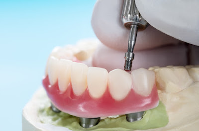 fixed teeth implants in bangalore