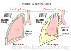 Malignant pleural mesothelioma