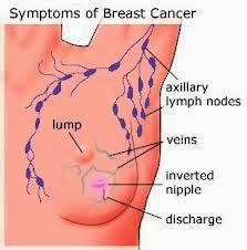  Breakdown of breast cancers -  Signs and Symptoms of breast cancer