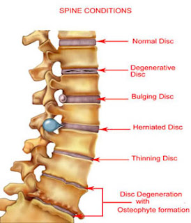 Lumbar Degenerative disc disease