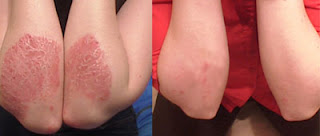 psoriasis natural remedies