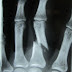 SANGAT PENTING PERLUNYA X-RAY UNTUK  "BROKEN FINGER" 