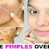 Remove Pimples OVERNIGHT  100% Success