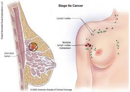 remedies for breast cancer