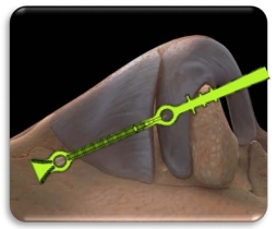 Spirox Latera™ Nasal Implant