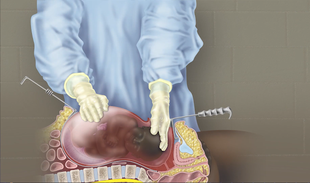 Delivery of fetus showing hand and instrument placement. (Graphic courtesy of Dr. Logan Peterson, USU)