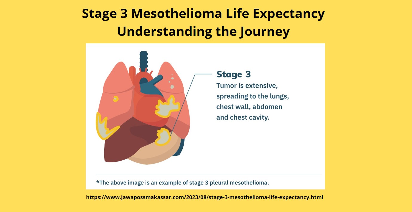 Stage 3 Mesothelioma Life Expectancy